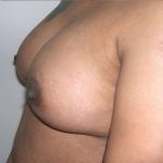 Breast Augmentation Before & After Patient #2207