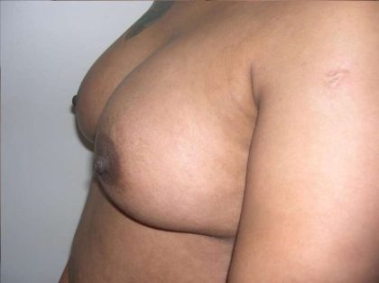 Breast Augmentation Before & After Patient #2207