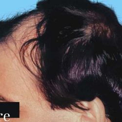 Hair Restoration Before & After Patient #2746
