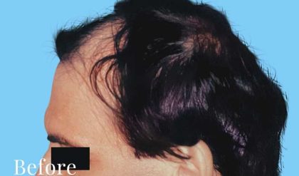 Hair Restoration Before & After Patient #2746
