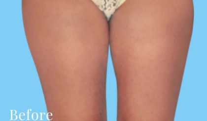 Liposuction Before & After Patient #2826