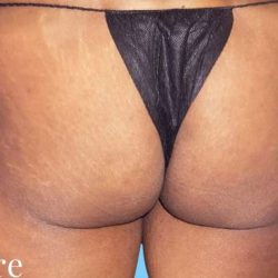 Buttock Augmentation Before & After Patient #2390