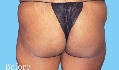 Buttock Augmentation Before & After Patient #2390
