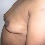 Breast Augmentation Before & After Patient #2207