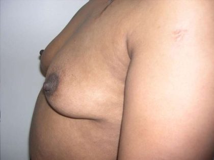 Breast Augmentation Before & After Patient #2207