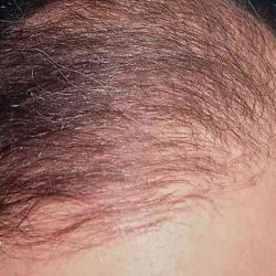 Hair Restoration Before & After Patient #2731