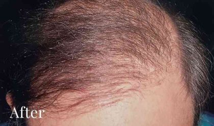Hair Restoration Before & After Patient #2731