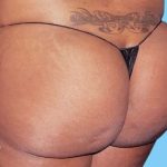 Buttock Augmentation Before & After Patient #2375