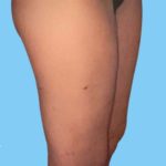 Liposuction Before & After Patient #2811