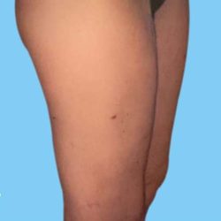 Liposuction Before & After Patient #2811