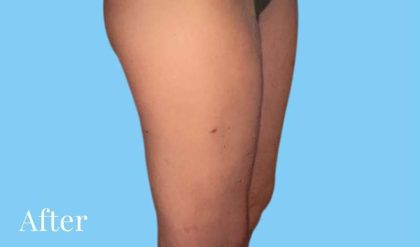Liposuction Before & After Patient #2811