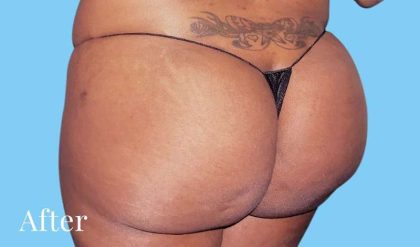 Buttock Augmentation Before & After Patient #2375