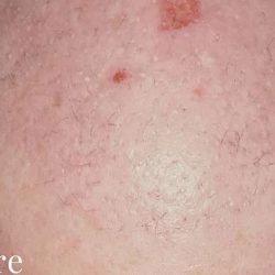 Hair Restoration Before & After Patient #2731