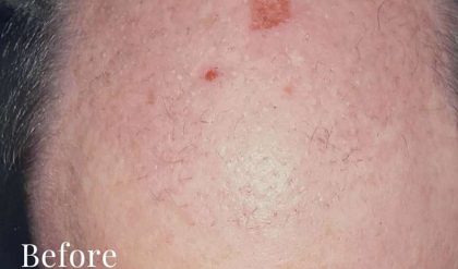 Hair Restoration Before & After Patient #2731