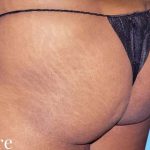 Buttock Augmentation Before & After Patient #2375