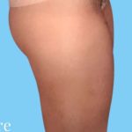 Liposuction Before & After Patient #2811