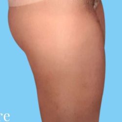 Liposuction Before & After Patient #2811