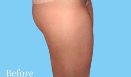 Liposuction Before & After Patient #2811