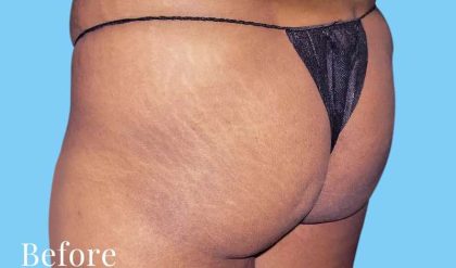 Buttock Augmentation Before & After Patient #2375