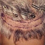 Hair Restoration Before & After Patient #2728