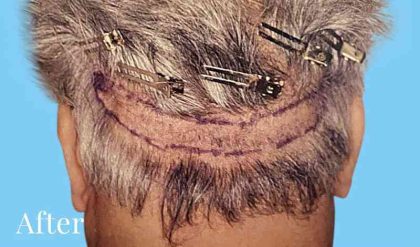 Hair Restoration Before & After Patient #2728