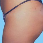 Buttock Augmentation Before & After Patient #2372