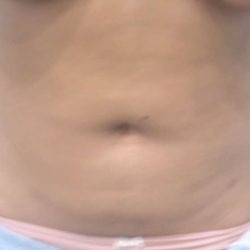 Liposuction Before & After Patient #2808