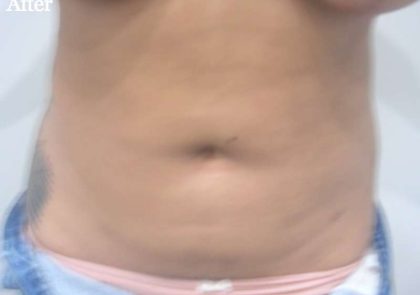 Liposuction Before & After Patient #2808