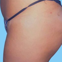 Buttock Augmentation Before & After Patient #2372