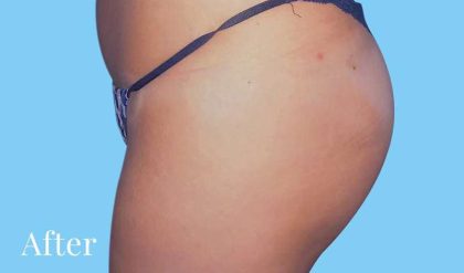 Buttock Augmentation Before & After Patient #2372