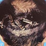 Hair Restoration Before & After Patient #2728