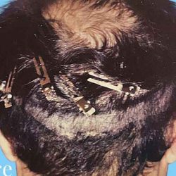 Hair Restoration Before & After Patient #2728