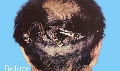 Hair Restoration Before & After Patient #2728