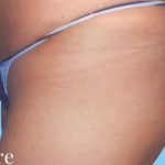 Buttock Augmentation Before & After Patient #2372