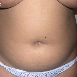 Liposuction Before & After Patient #2808