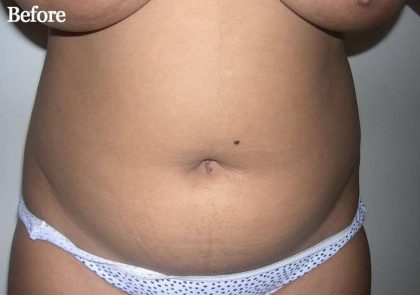 Liposuction Before & After Patient #2808