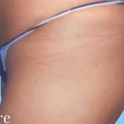 Buttock Augmentation Before & After Patient #2372