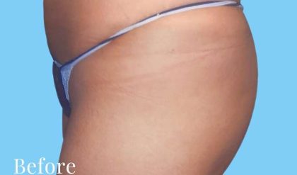 Buttock Augmentation Before & After Patient #2372