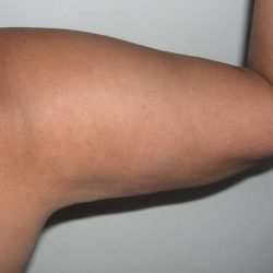Liposuction Before & After Patient #2829