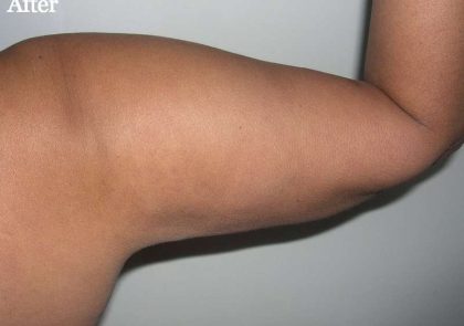 Liposuction Before & After Patient #2829