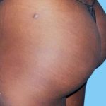 Buttock Augmentation Before & After Patient #2393