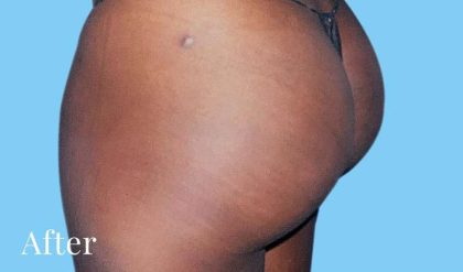Buttock Augmentation Before & After Patient #2393