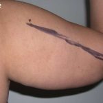 Liposuction Before & After Patient #2829
