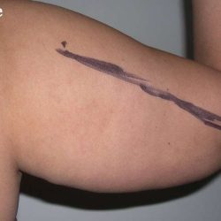 Liposuction Before & After Patient #2829