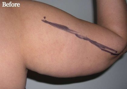 Liposuction Before & After Patient #2829