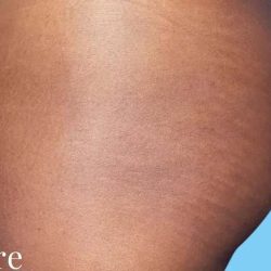 Buttock Augmentation Before & After Patient #2393