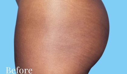Buttock Augmentation Before & After Patient #2393