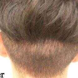 Hair Restoration Before & After Patient #2787
