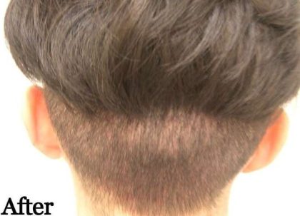 Hair Restoration Before & After Patient #2787