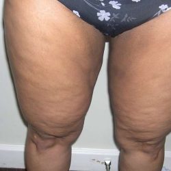 Liposuction Before & After Patient #2870